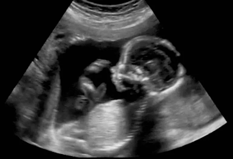 Calcification of Placenta in Pregnancy