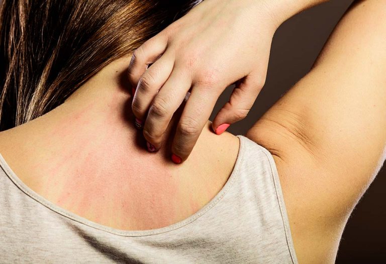 12 Effective Home Remedies for Itchy Skin - Natural Healing for Irritation and Scratchiness