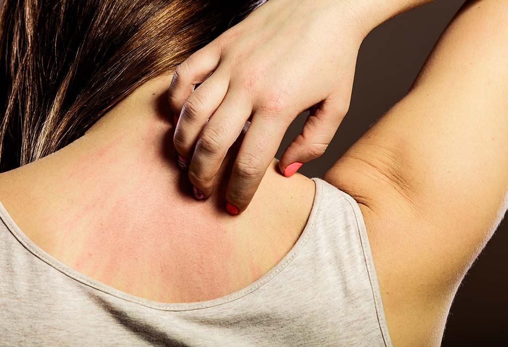 12 Effective Home Remedies to Get Rid of Itching on Skin