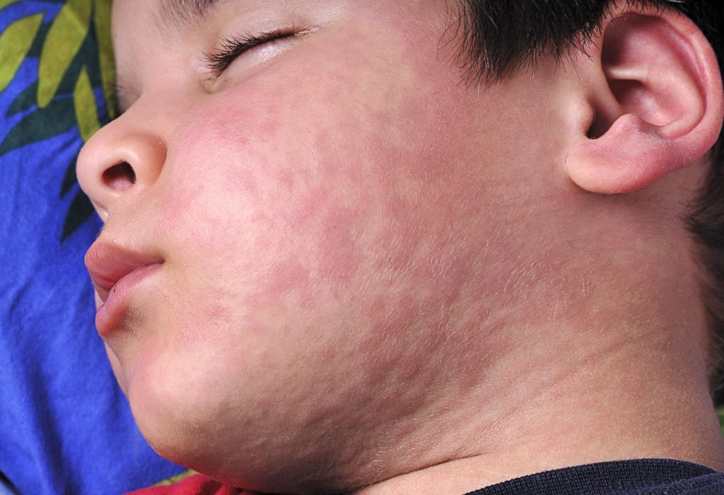 measles