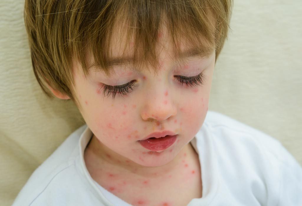chicken pox