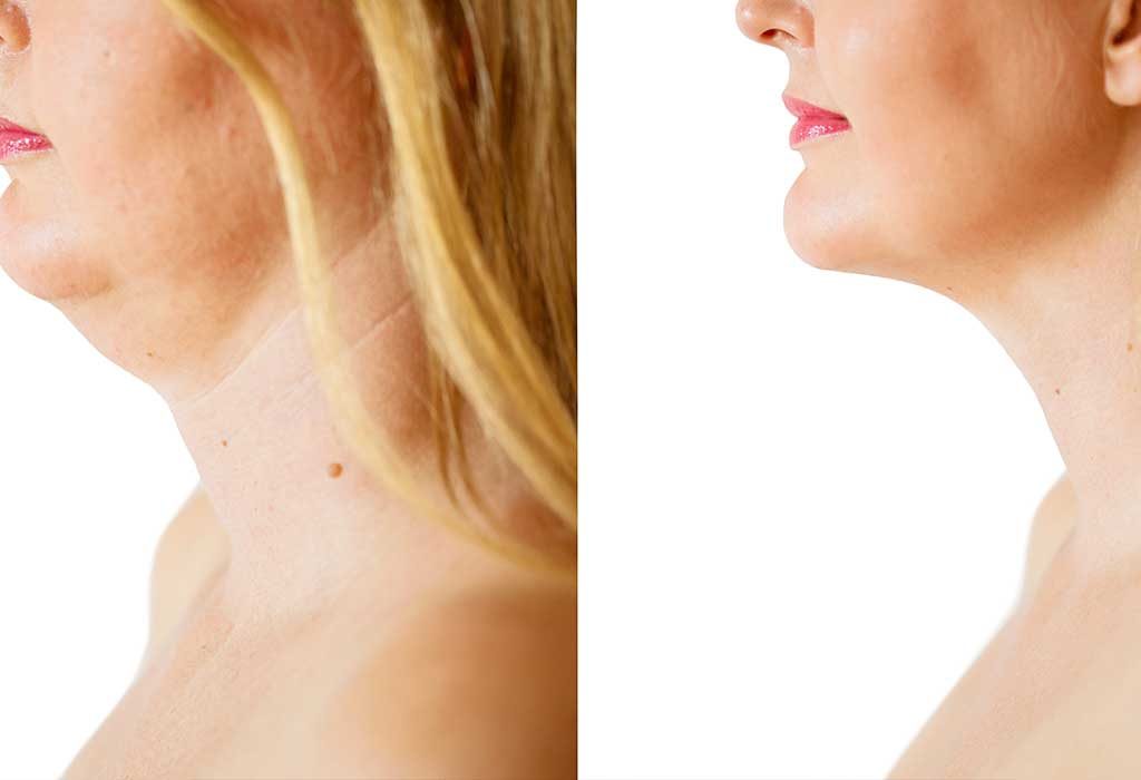 How to get rid of fat back of online neck