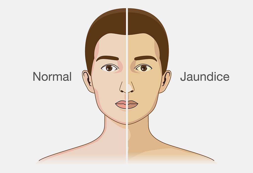 Diet Chart for Jaundice Patient Foods to Eat & Avoid