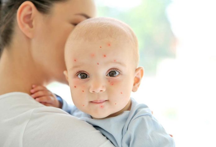 When My Baby Got Chicken Pox- Symptoms, Treatment and After Care