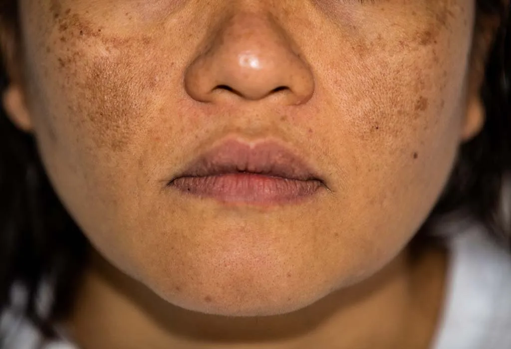 Improves Complexion