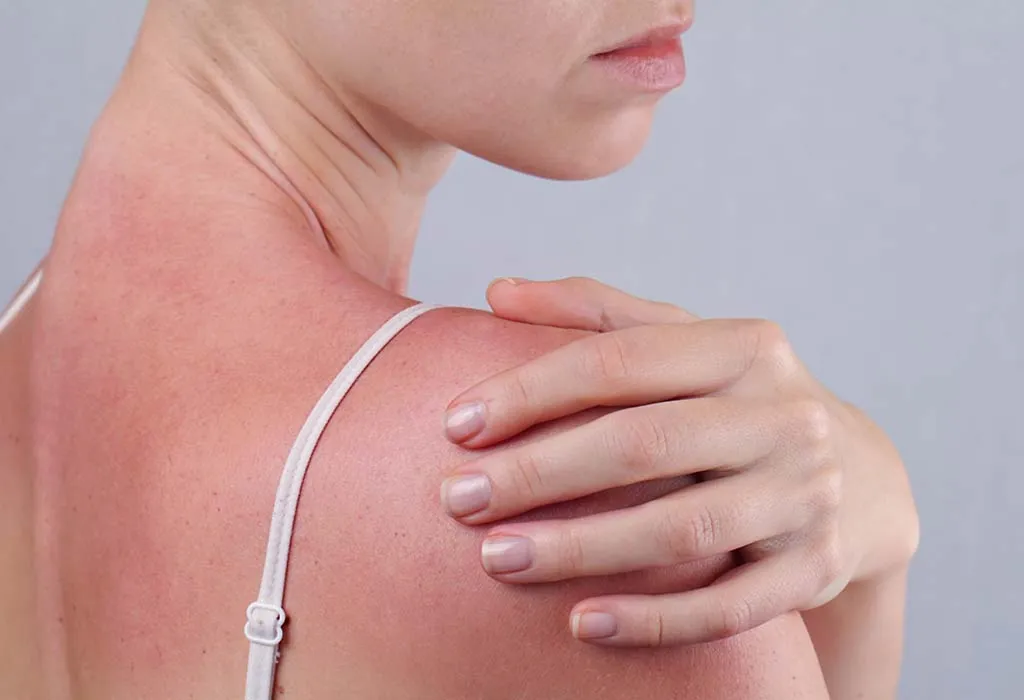 Protects from Sunburn
