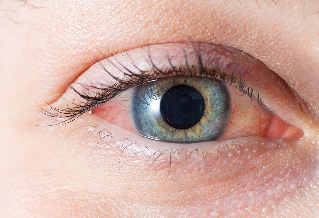 treat-red-eyes-at-home-eye-care-cool-eyes-eyes