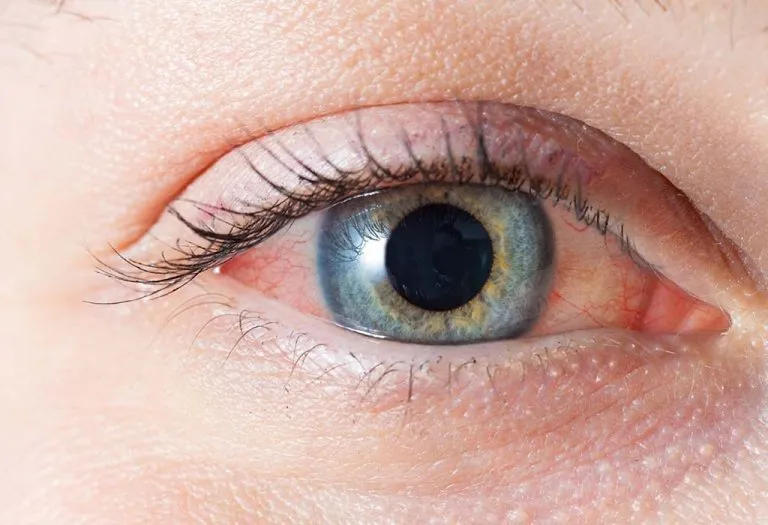 11 Ways to Treat Red Eyes