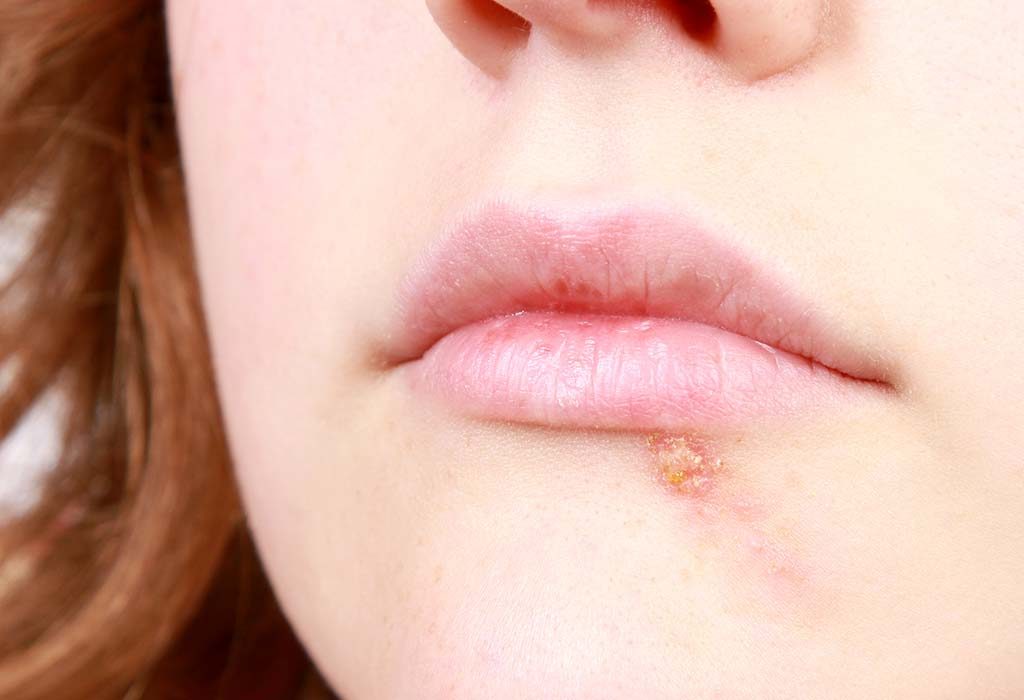 cold sores on lips early stages