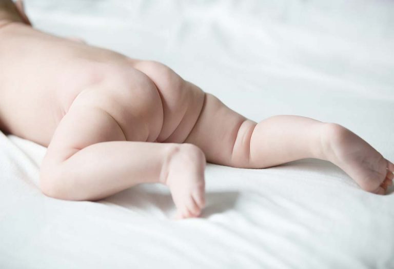 Sacral Dimple - Causes, Complications, and Treatment