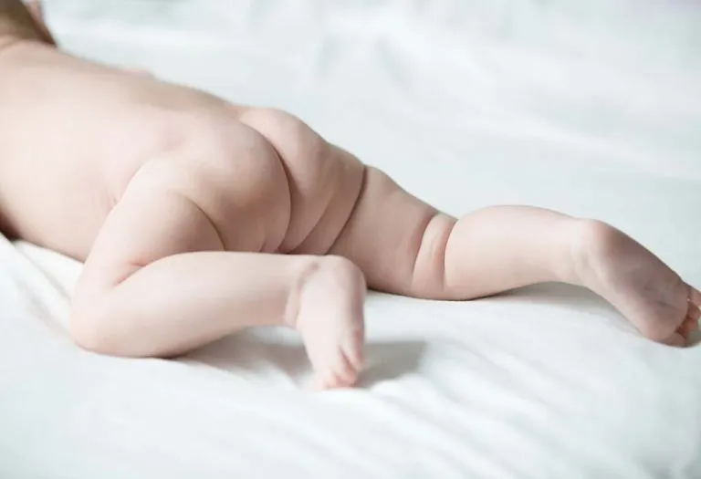 Sacral Dimple - Causes, Complications, and Treatment