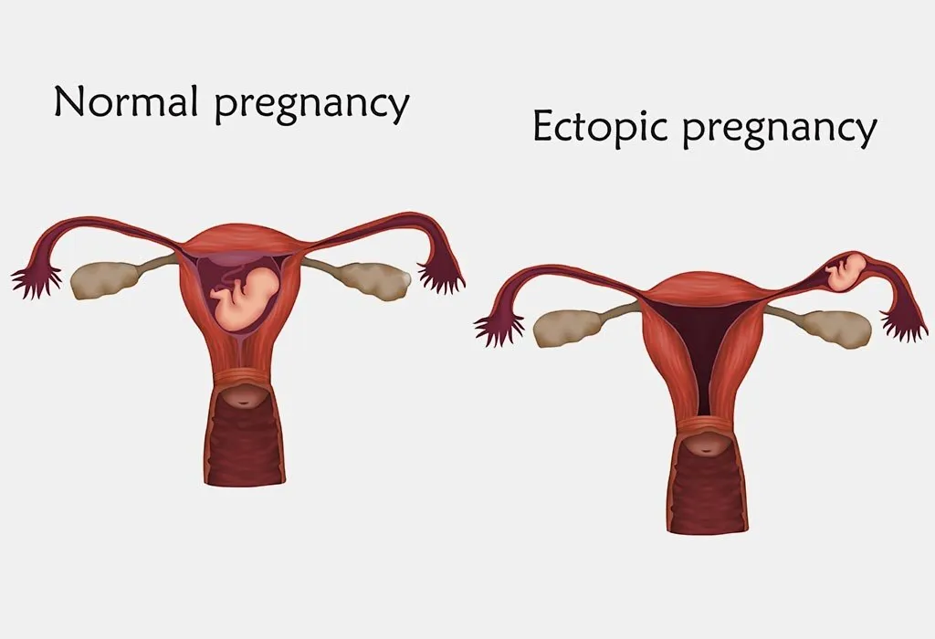 Abdominal pregnancy