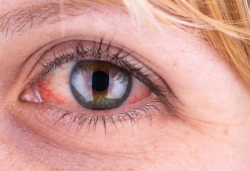 A woman with red eyes