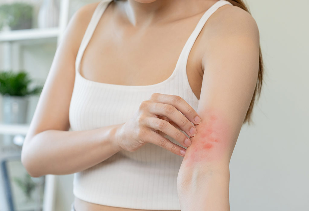 Eczema After Pregnancy – Causes and Tips to Handle It