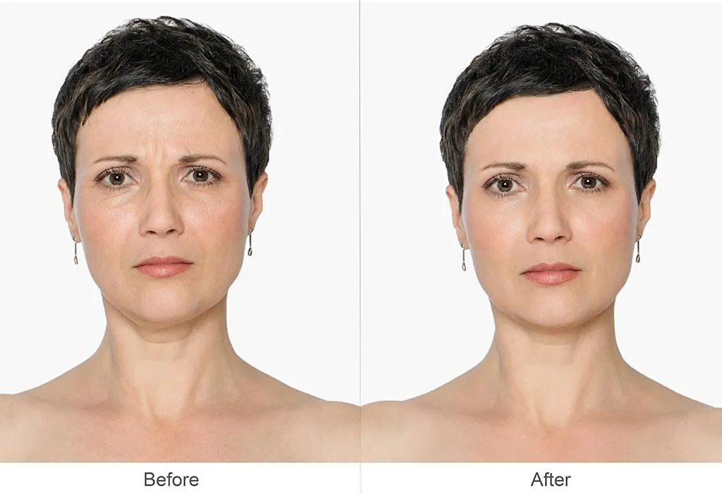 What Is Botox Treatment?