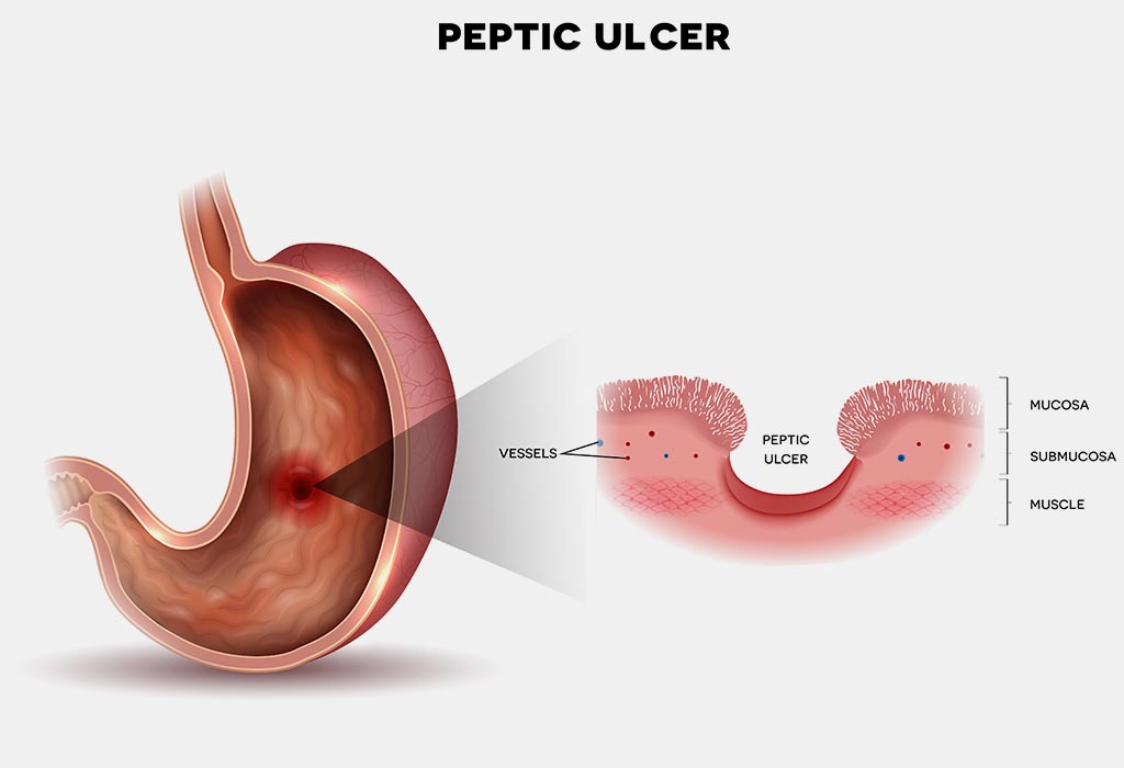 Peptisches Geschwür