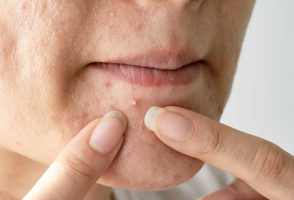 How to Get Rid of Pimples on Chin Causes & Prevention
