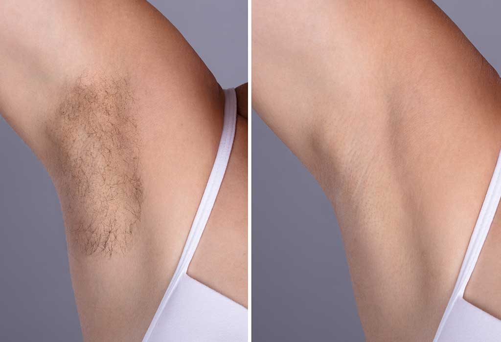 9 Effective Ways To Remove Underarm Armpit Hair