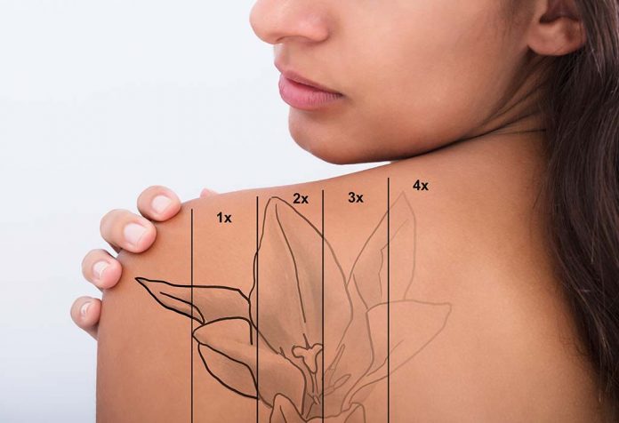 10 Ways to Remove Your Permanent Tattoo That are Super