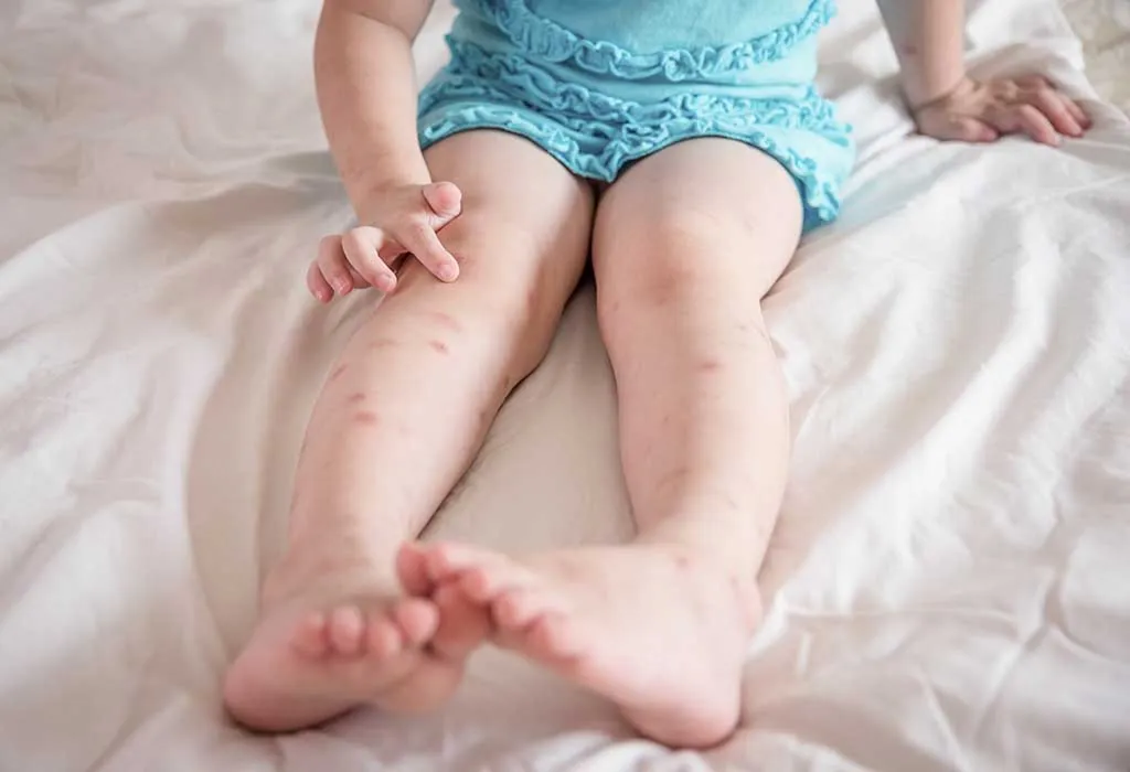 Remedies for mosquito bites