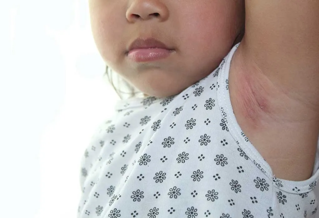 Remedies for heat rash