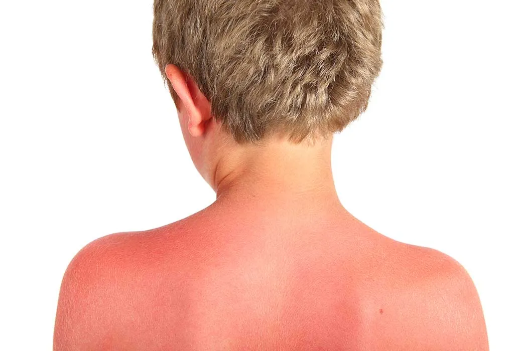 Remedies for sunburn