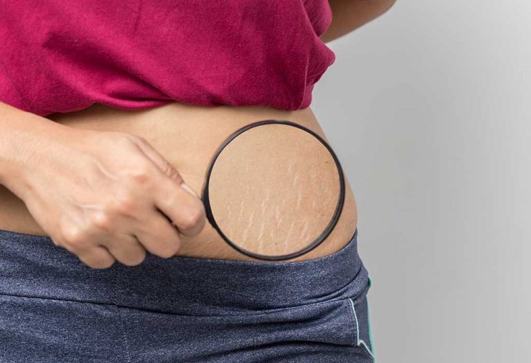 How to Get Rid of Stretch Marks After Pregnancy?