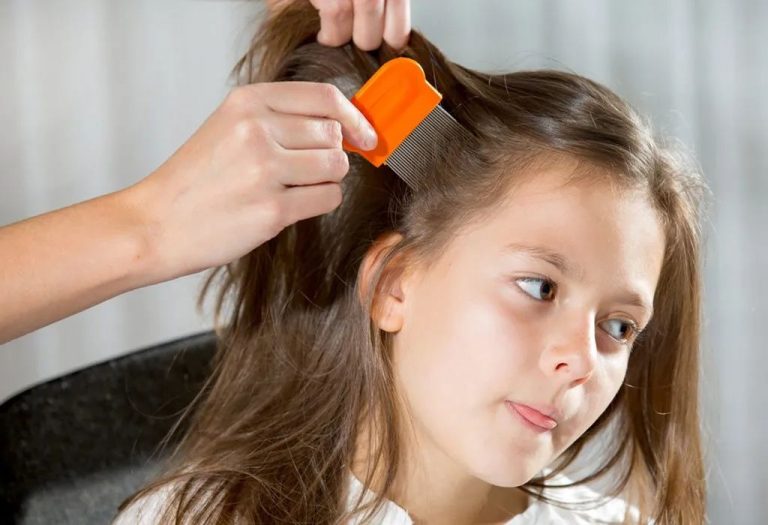 17 Home Remedies for Head Lice in Kids