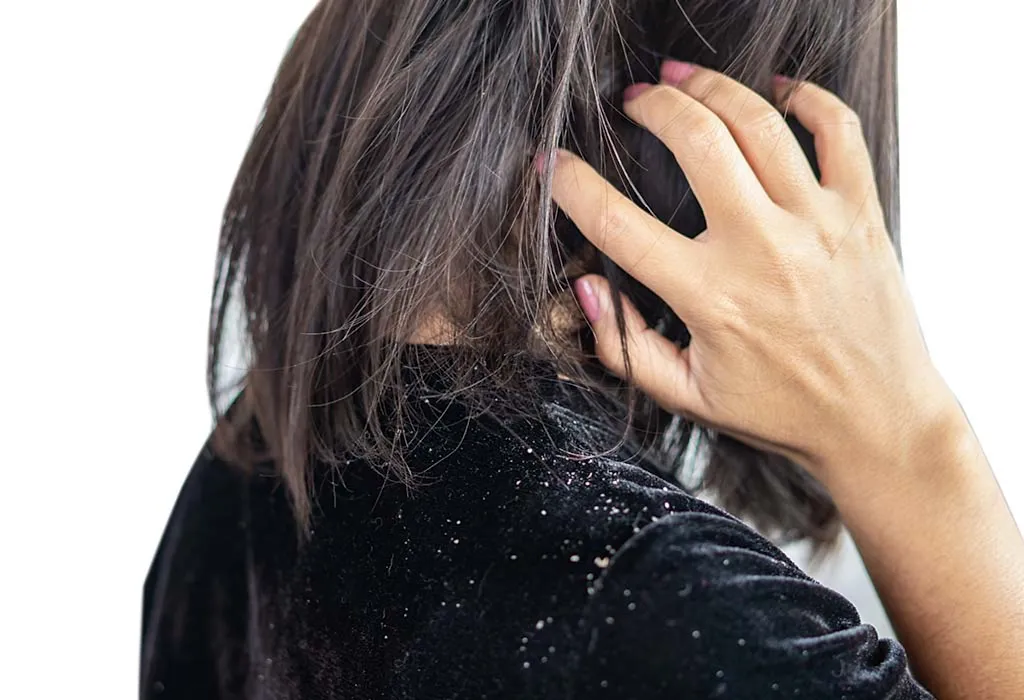 woman with dandruff
