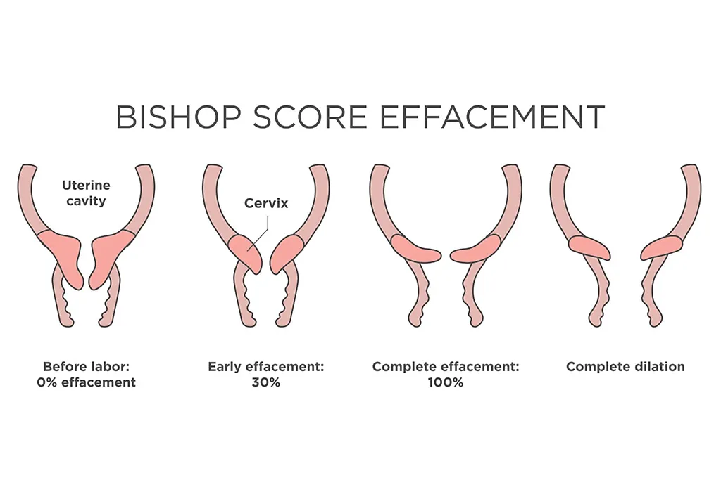 Bishop Score For Labour Induction bishop-score-for-labour-induction