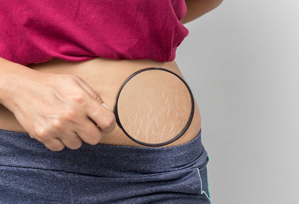 How to get rid of stretch marks after pregnancy