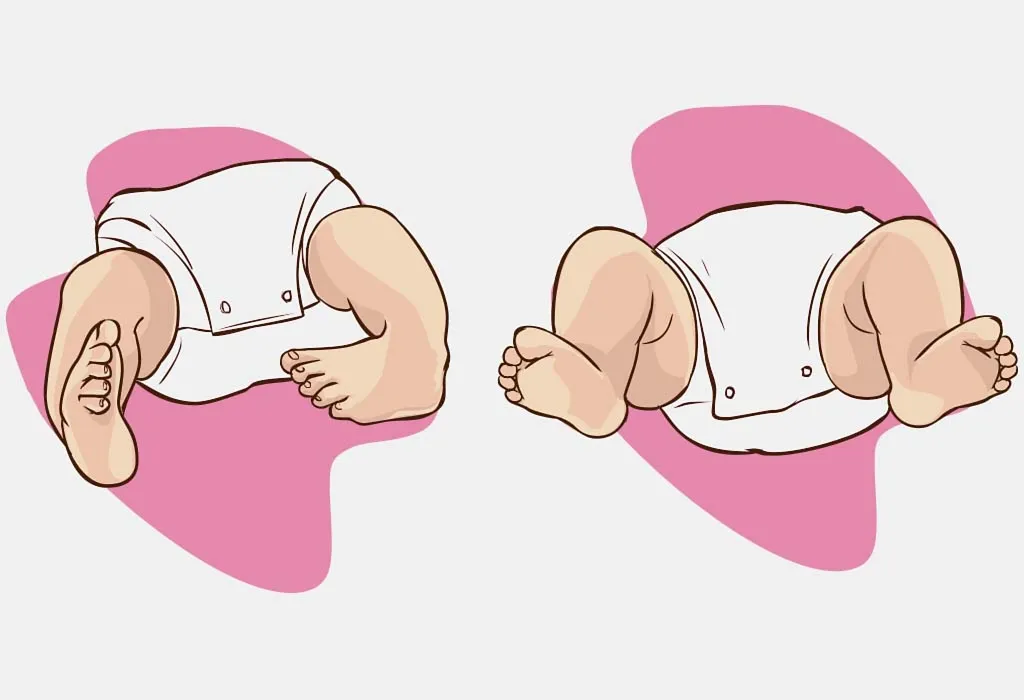 Congenital Talipes Equinovarus Or Clubfoot Causes And Treatment