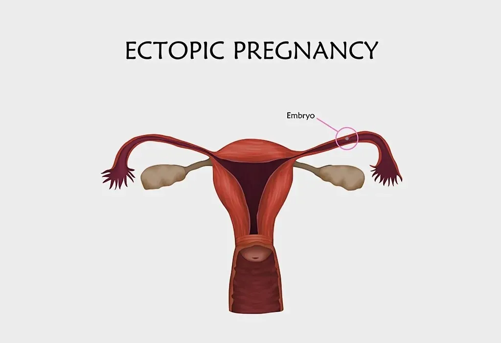 early pregnancy brown discharge