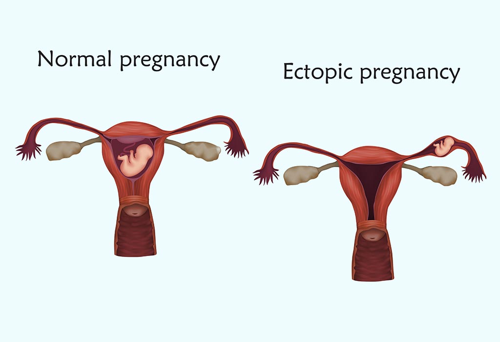 Menstrual Cramps Are Common, But Not Normal