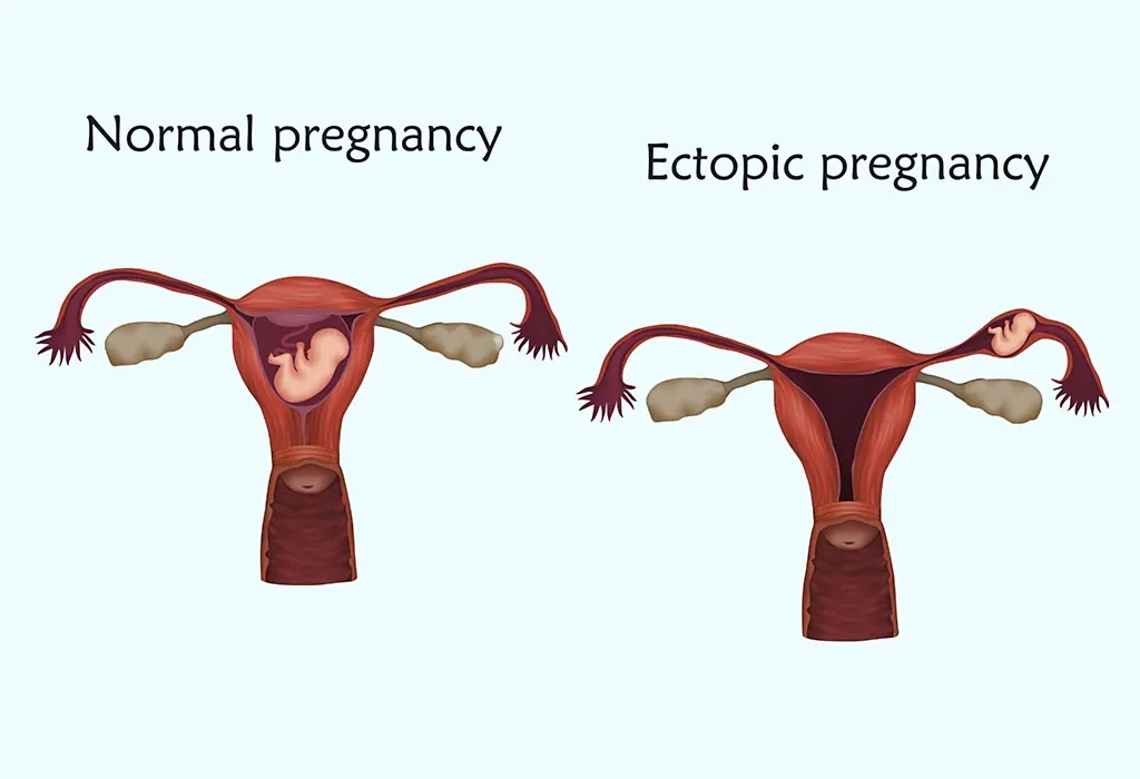 Do Cramps But No Period Mean Pregnancy? Experts Explain