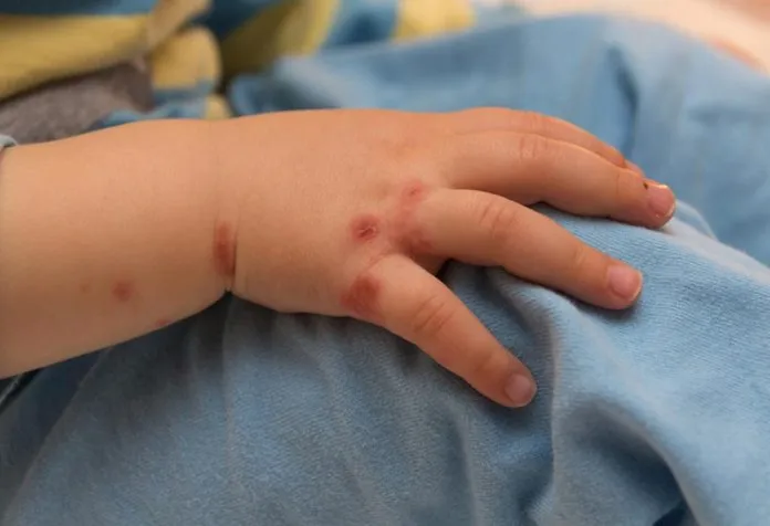 20 Home Remedies for Hand, Foot, and Mouth Disease