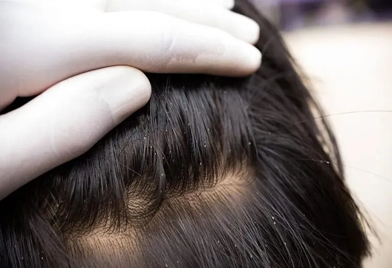 Head Lice in a Baby or Child: How to Get Rid of Them?
