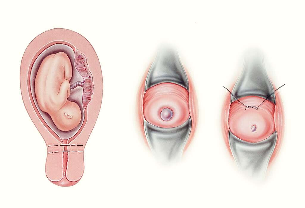 गर्भाशय में अब्नॉर्मलिटीज के लिए कॉमन ट्रीटमेंट 