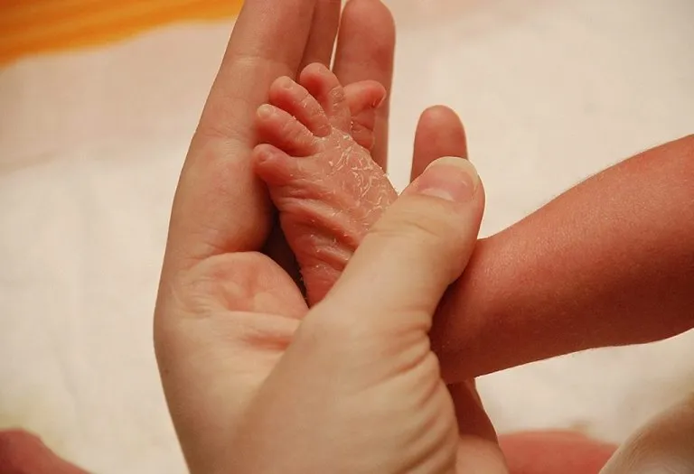 Baby Dry Skin: Symptoms, Causes and Treatment