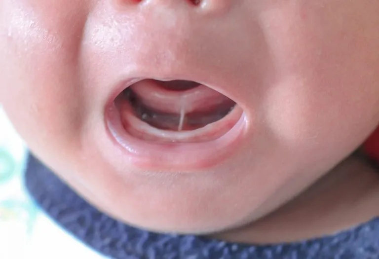 Tongue Tie (Ankyloglossia) - Types, Causes, Symptoms & Treatment