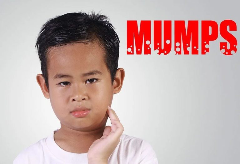 Mumps in Children - Causes, Symptoms and Treatment