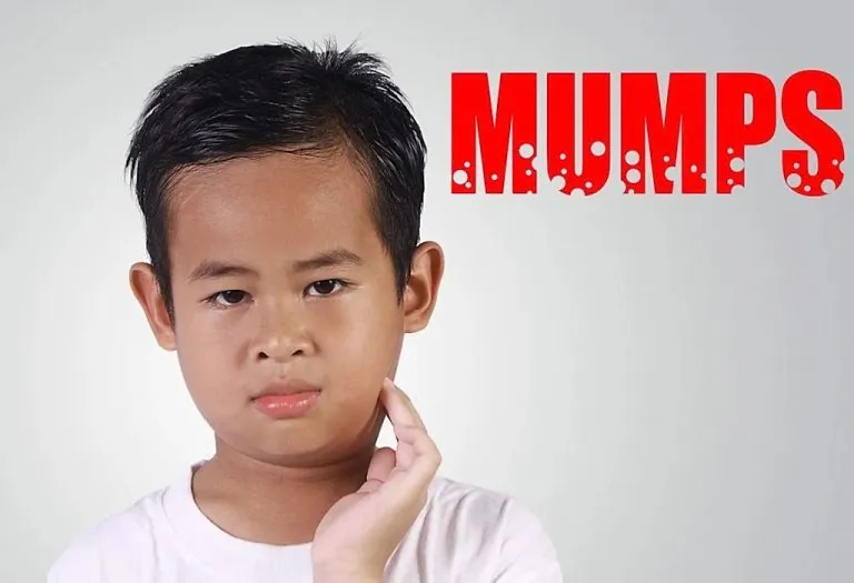 Mumps in Children - Causes, Symptoms and Treatment