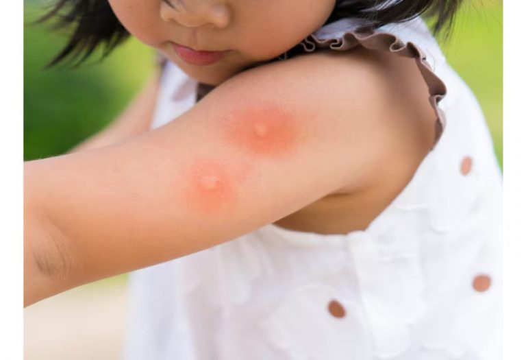 Dengue Fever in Children - Symptoms, Treatment and Prevention