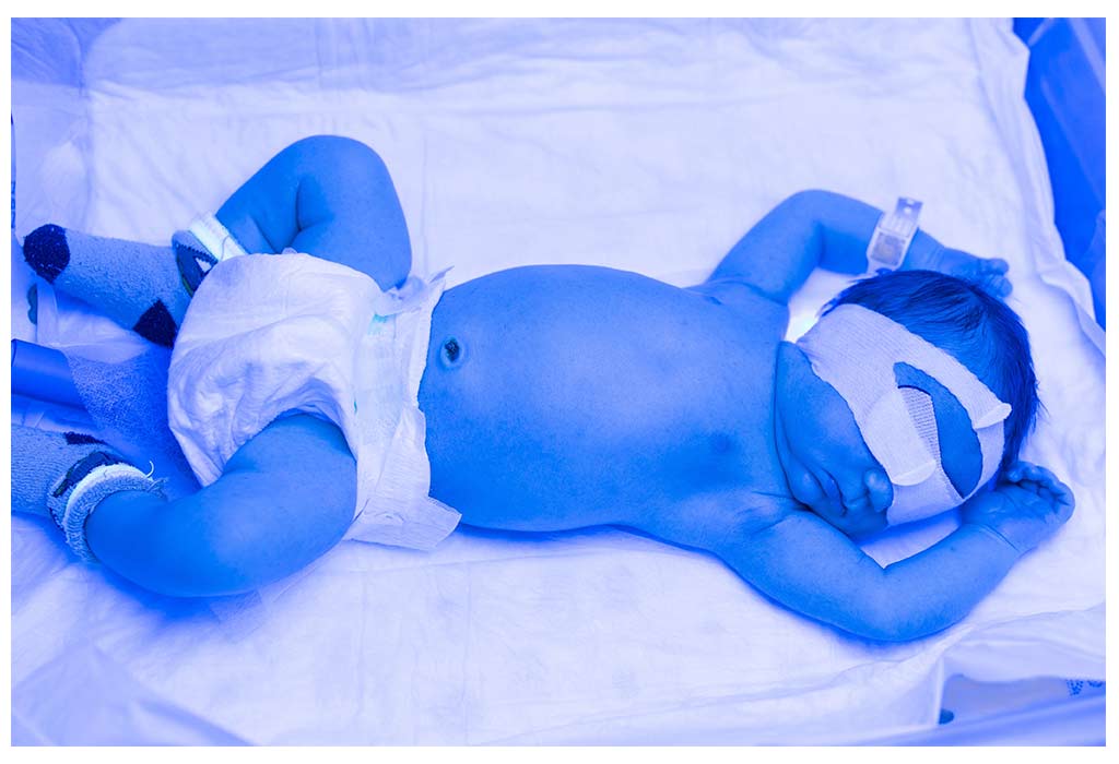 dark skin neonatal jaundice
