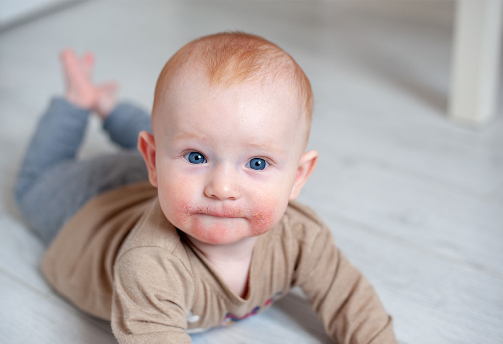 Allergy in babies