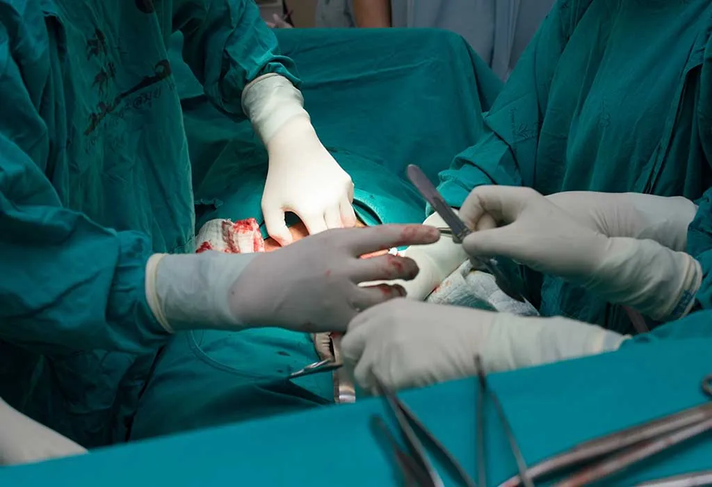 Caesarean delivery