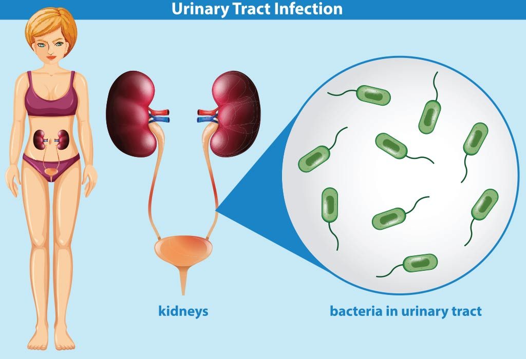 Urinary Tract Infection In Women 6637