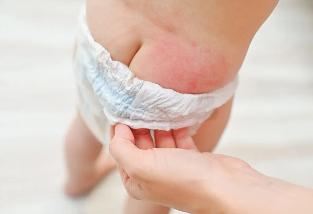 Diaper-rash