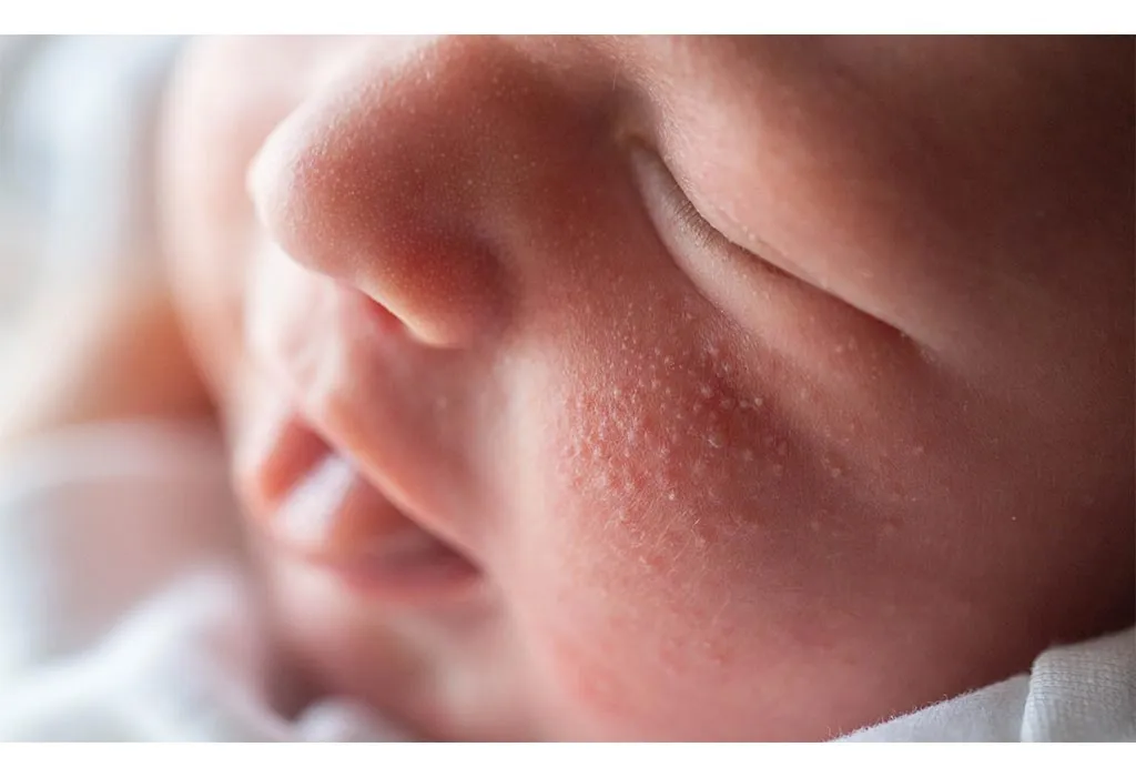 Baby-acne
