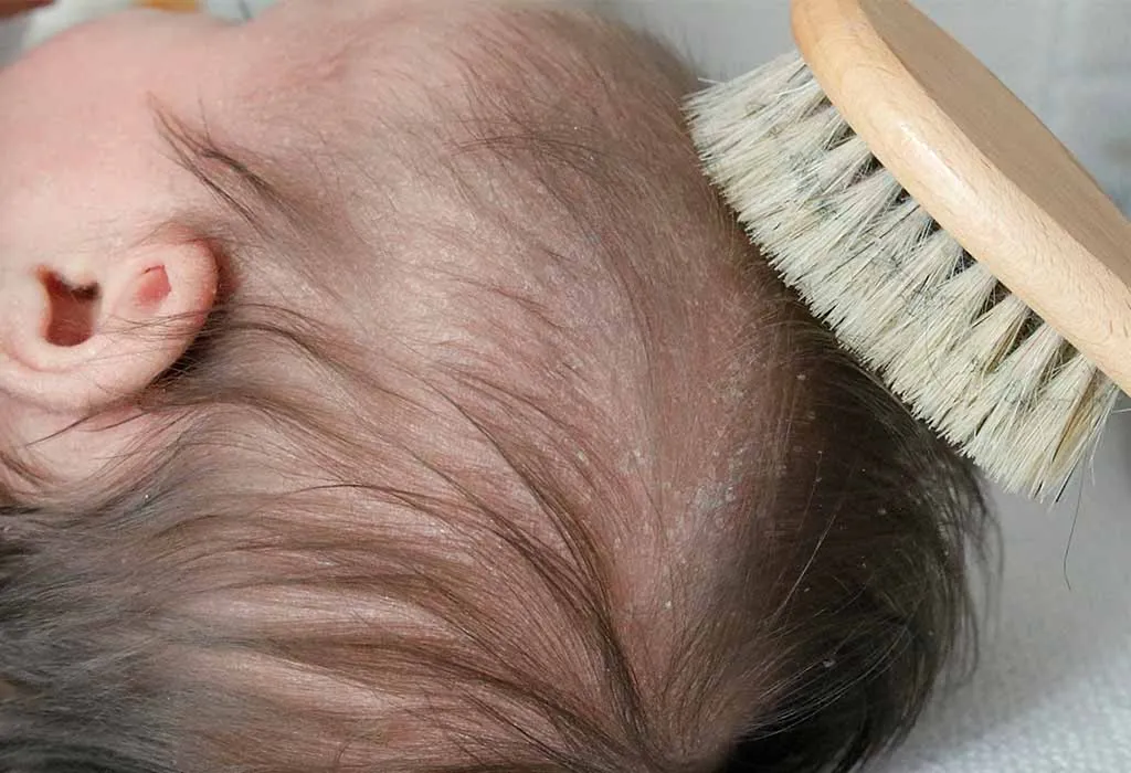 Cradle-cap